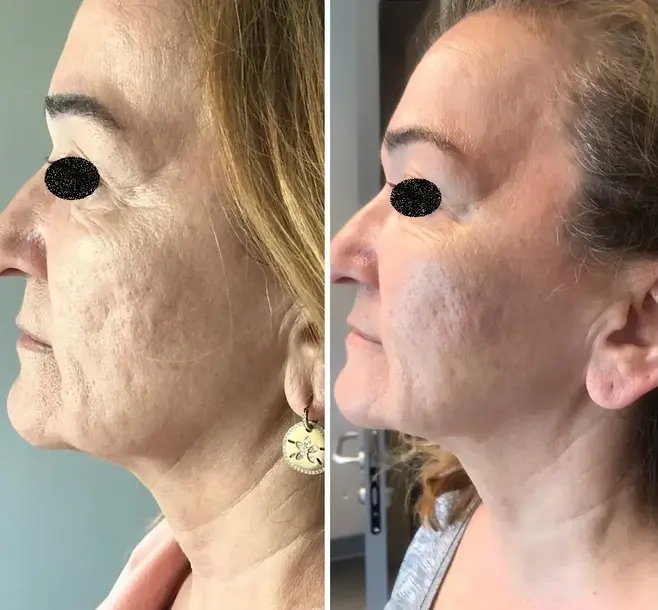 Morpheus8 Fractional Microneedling Before After - Fractional Microneedling