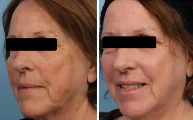 Fractional Laser Skin Spot Treatment