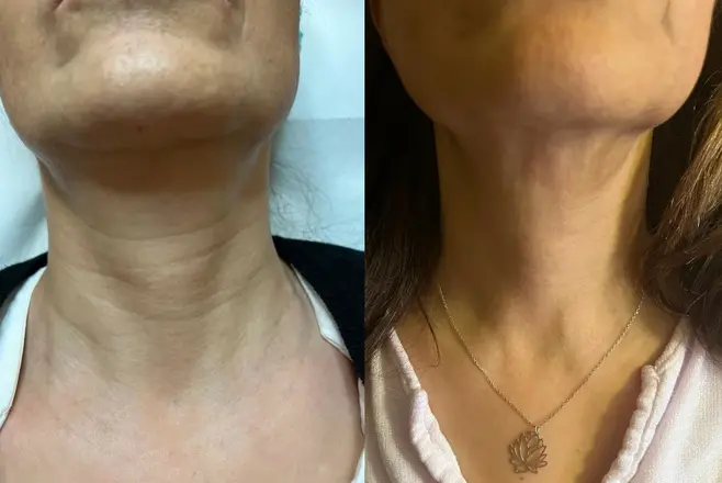 Morpheus8 Before After Fractional Microneedling